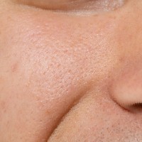 液態皮秒天使肌光感課程 液態皮秒天使肌光感課程