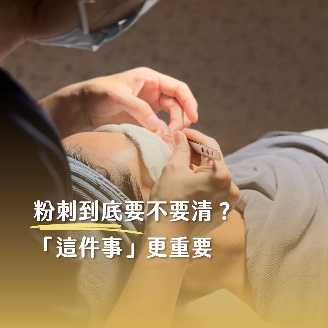 粉刺到底要不要清？「這件事」更重要